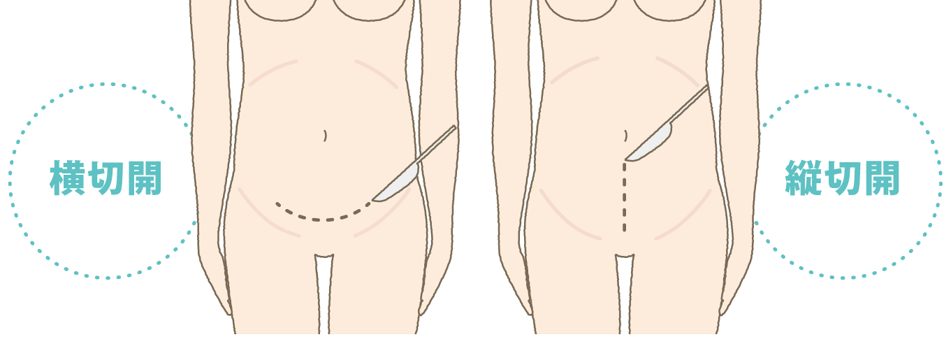 帝王切開の切開方法の図